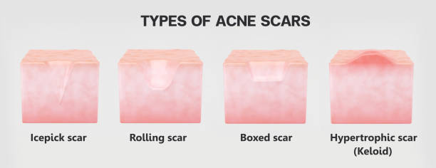 moderate acne scars prevention
Types of scar
Icepick scar
Rolling scar
Boxed scar
Hypertrophic scar