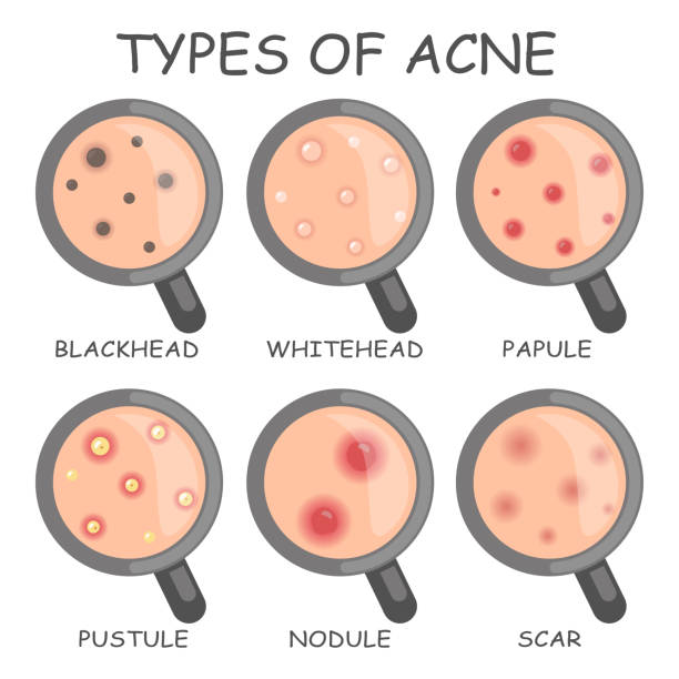 Types of acne and home remedies