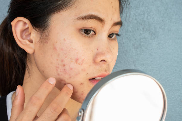 How to Remove Acne Scars Naturally in a Week