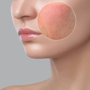 How to Remove Acne Scars Naturally in a Week: My Journey from Hopeless to Radiant