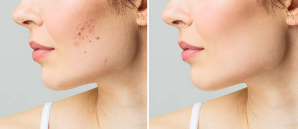 The Ordinary Niacinamide 10% + Zinc 1%