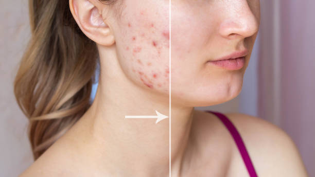 Natural remedies for scars