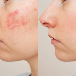 natural scar removal from home