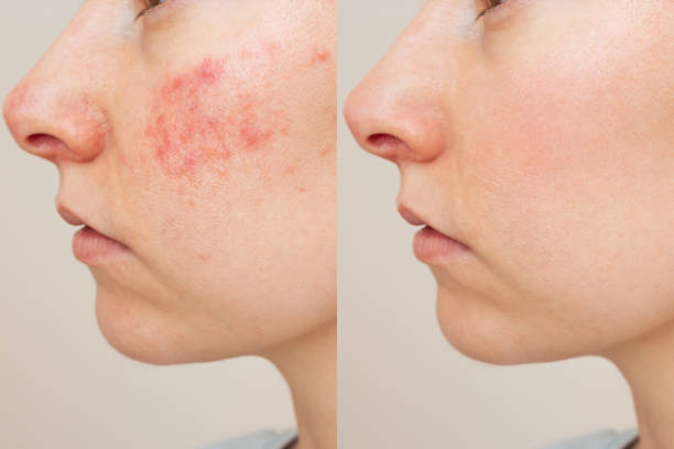 natural scar removal from home
