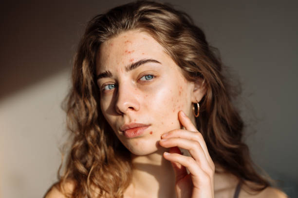 Best Retinol for acne scar