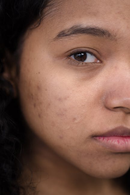 Acne scar